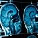 Covid Vaccine Prion Disease