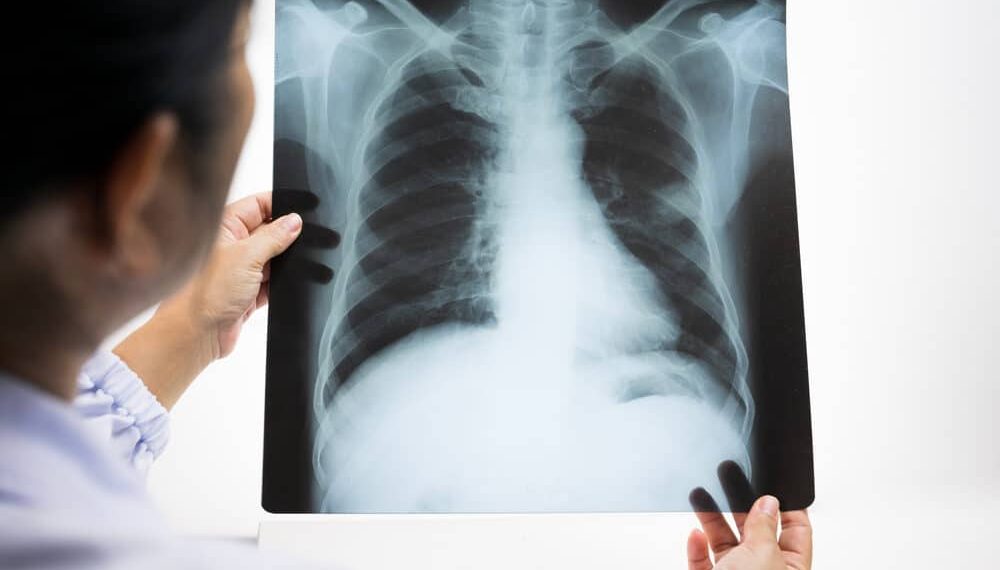 WHO is now monitoring cases of pneumonia of “unknown origin”
