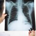 WHO is now monitoring cases of pneumonia of “unknown origin”