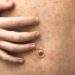 Measles