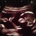 13 Pro-Life Groups Send Letter Telling Walgreen and CVS: Stop Selling Abortion Pills