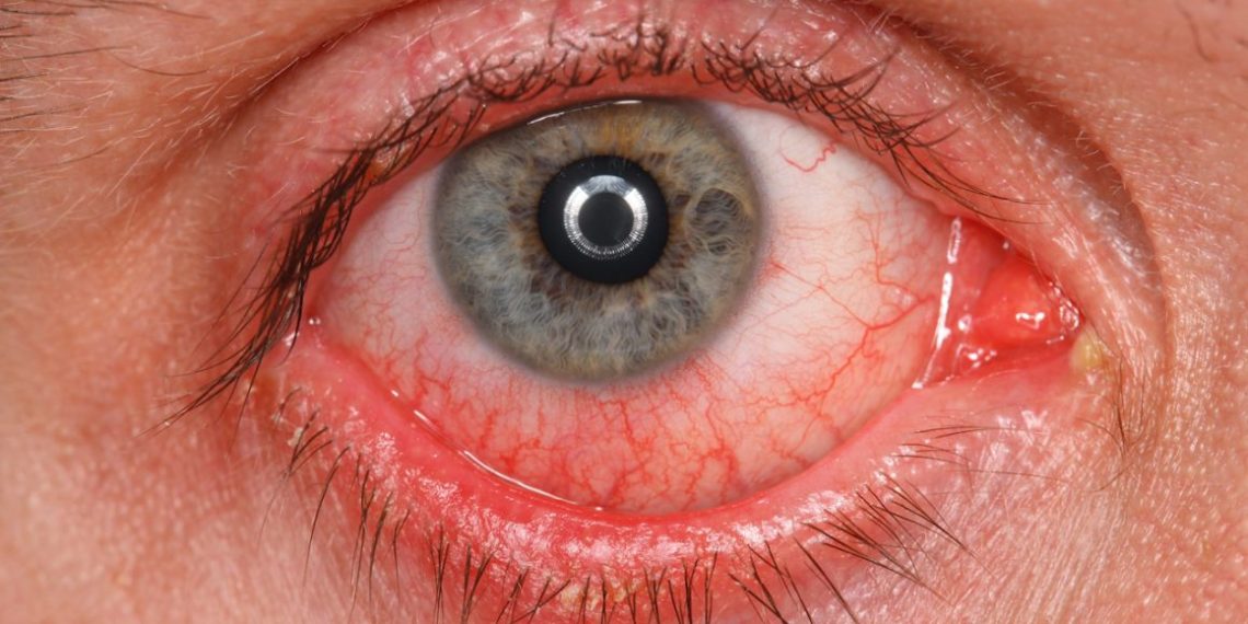 COVID Vaccines Linked to Untreatable Eyeball Clots, Reveals Massive Study.