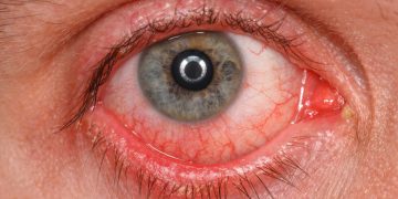 COVID Vaccines Linked to Untreatable Eyeball Clots, Reveals Massive Study.