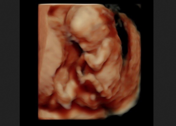 62,000 Babies Older Than 15 Weeks are Killed in Abortions Every Year