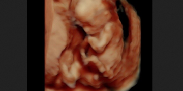 62,000 Babies Older Than 15 Weeks are Killed in Abortions Every Year
