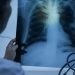 Tuberculosis