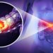 Colon Cancer