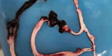 Clots